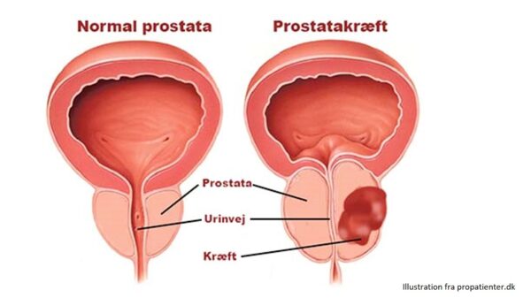 prostatakraeft propatienter Illustration af normal prostata og prostatakræft. Del af information om prostatakræft symptomer og fakta