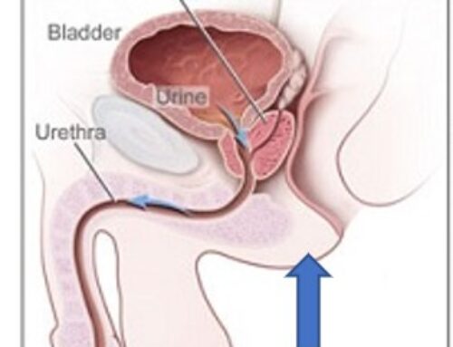 Biopsi af prostata gennem mellemkødet